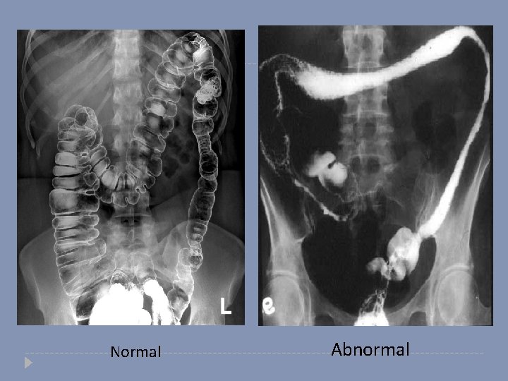 Normal Abnormal 