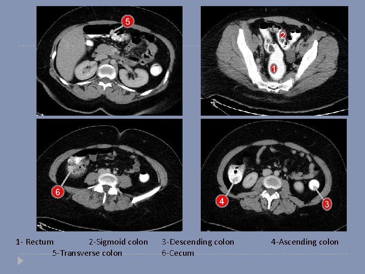 5 2 1 6 1 - Rectum 2 -Sigmoid colon 5 -Transverse colon 4