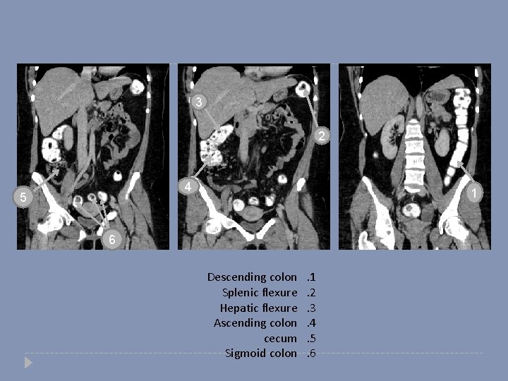 3 2 4 5 1 6 Descending colon Splenic flexure Hepatic flexure Ascending colon