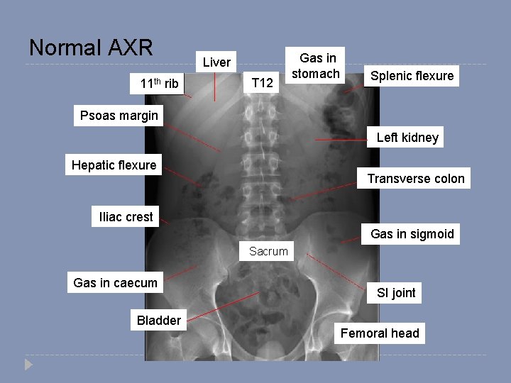 Normal AXR 11 th rib Liver T 12 Gas in stomach Splenic flexure Psoas