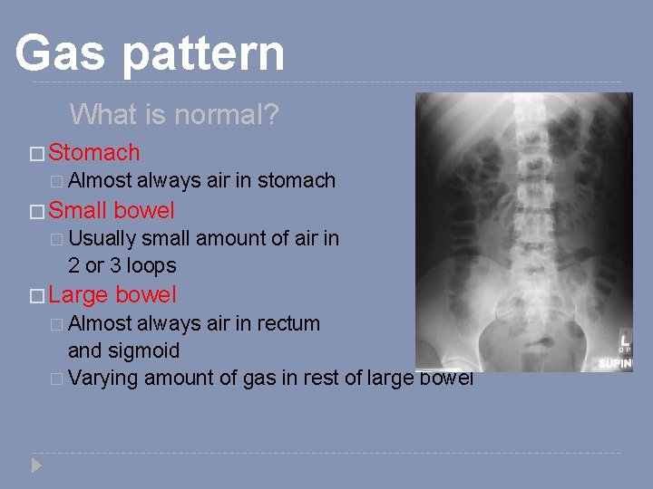 Gas pattern What is normal? � Stomach � Almost � Small always air in