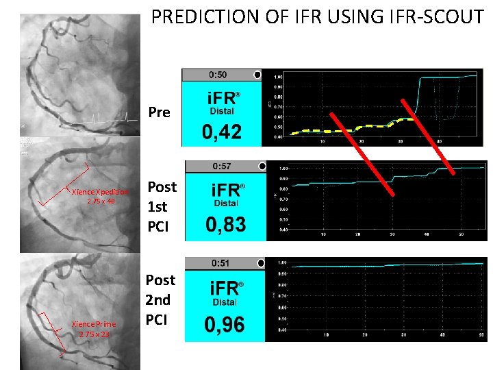 PREDICTION OF IFR USING IFR-SCOUT Pre Xience Xpedition 2. 75 x 48 Xience Prime