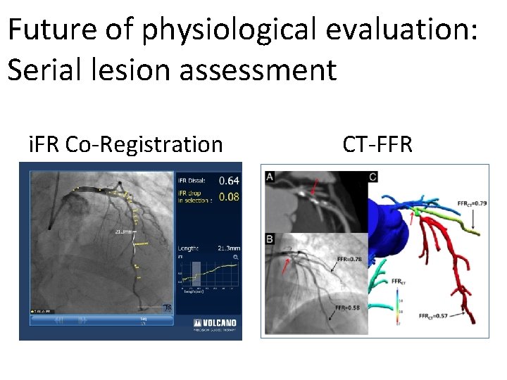 Future of physiological evaluation: Serial lesion assessment i. FR Co-Registration CT-FFR 