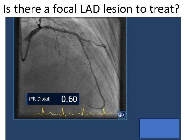 Is there a focal LAD lesion to treat? 