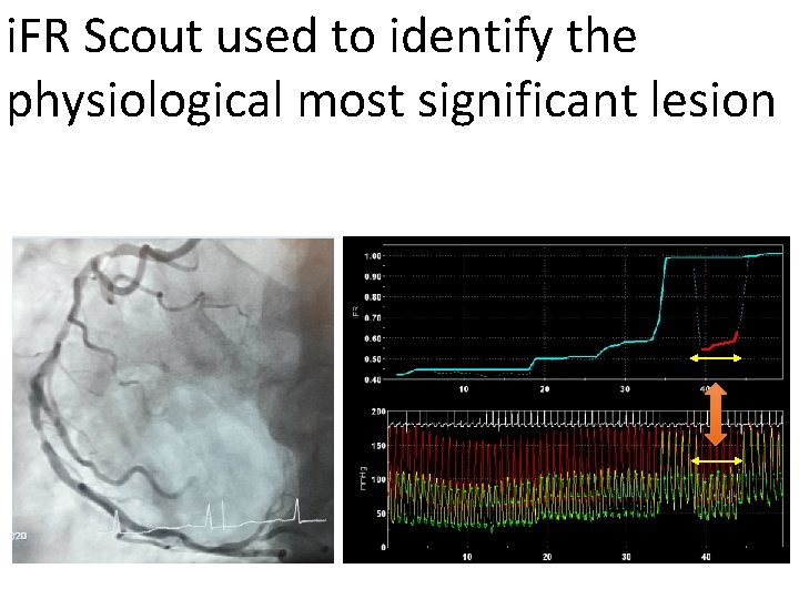 i. FR Scout used to identify the physiological most significant lesion 