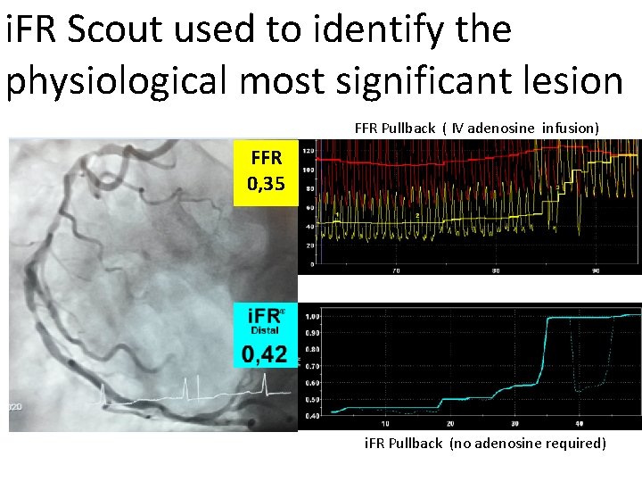 i. FR Scout used to identify the physiological most significant lesion FFR Pullback (
