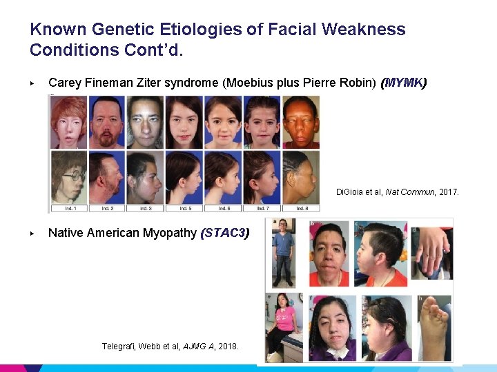 Known Genetic Etiologies of Facial Weakness Conditions Cont’d. ▶ Carey Fineman Ziter syndrome (Moebius