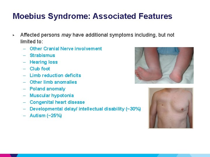 Moebius Syndrome: Associated Features ▶ Affected persons may have additional symptoms including, but not