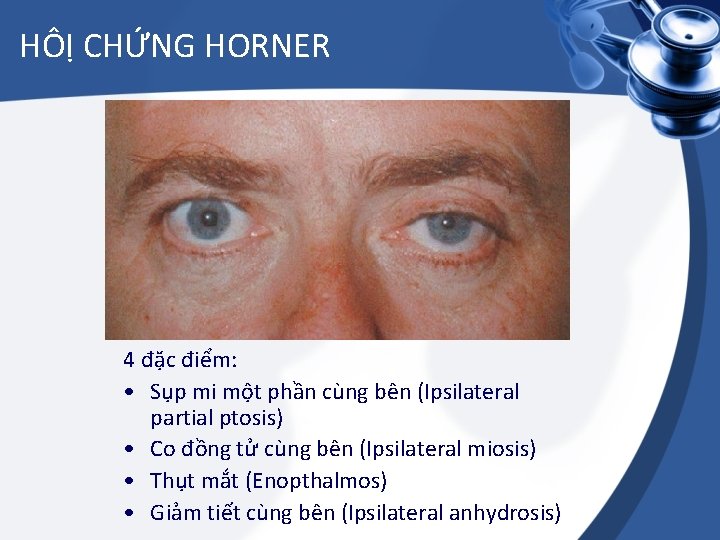 HÔỊ CHỨNG HORNER 4 đặc điểm: • Sụp mi một phần cùng bên (Ipsilateral