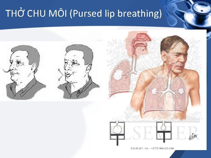 THỞ CHU MÔI (Pursed lip breathing) 