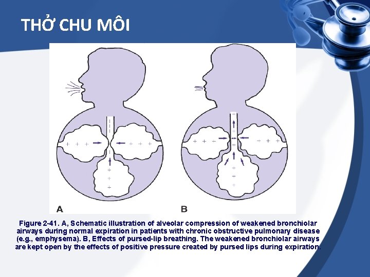 THỞ CHU MÔI Figure 2 -41. A, Schematic illustration of alveolar compression of weakened