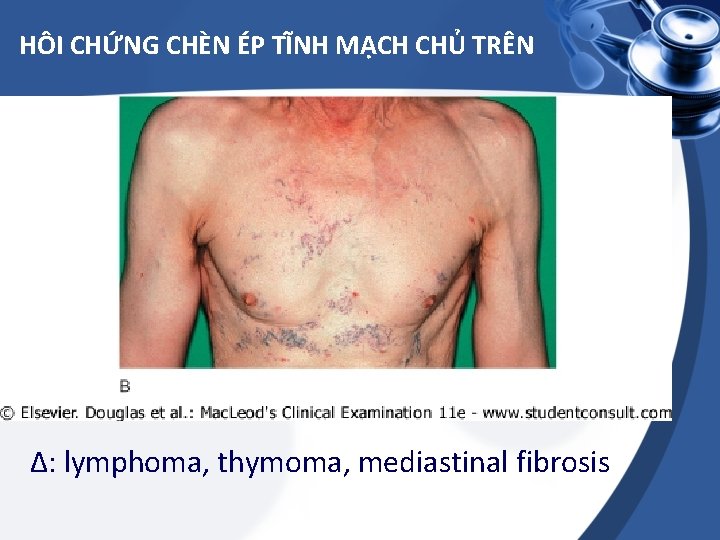 HÔI CHỨNG CHÈN ÉP TĨNH MẠCH CHỦ TRÊN Δ: lymphoma, thymoma, mediastinal fibrosis 