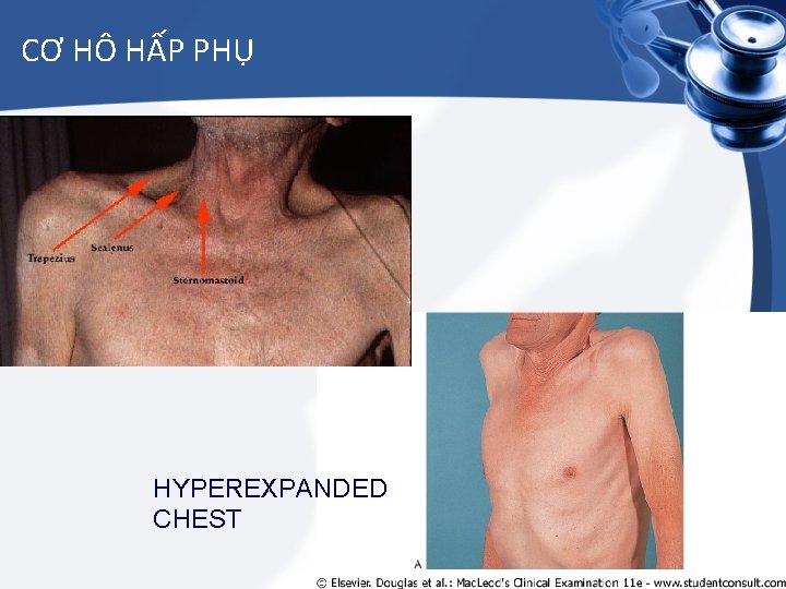 CƠ HÔ HẤP PHỤ HYPEREXPANDED CHEST 