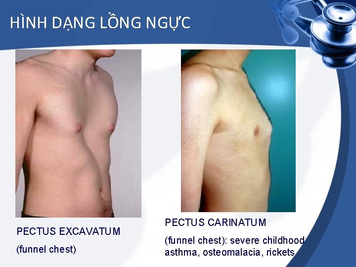 HÌNH DẠNG LỒNG NGỰC PECTUS EXCAVATUM (funnel chest) PECTUS CARINATUM (funnel chest): severe childhood