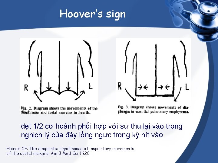 Hoover’s sign dẹt 1/2 cơ hoành phối hợp với sự thu lại vào trong