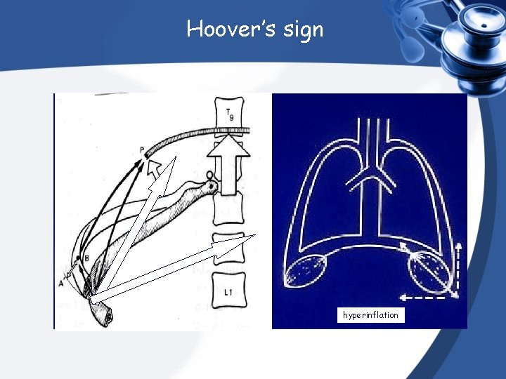 Hoover’s sign normal hyperinflation 