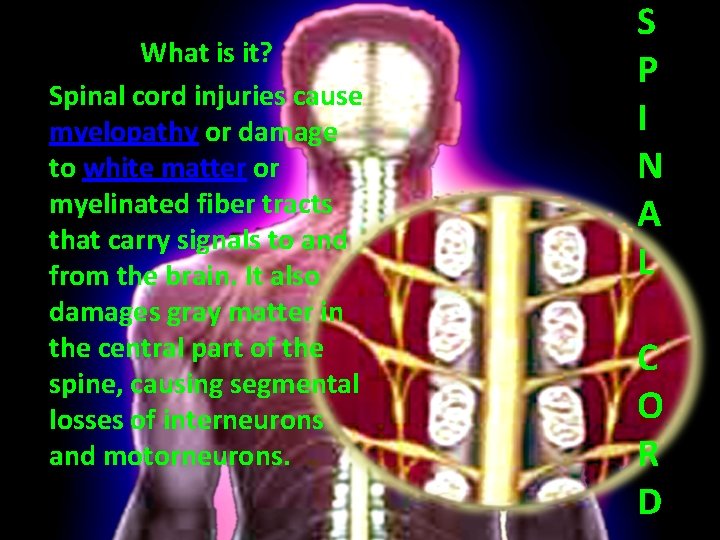 What is it? Spinal cord injuries cause myelopathy or damage to white matter or