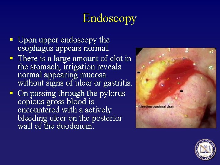 Endoscopy § Upon upper endoscopy the esophagus appears normal. § There is a large