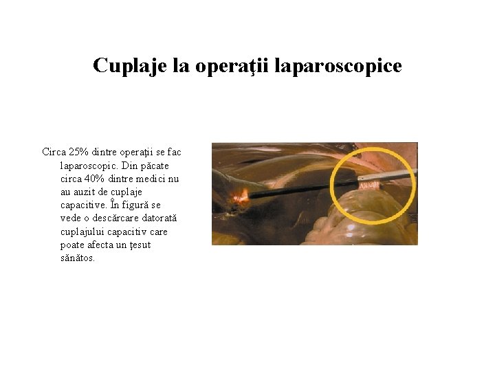 Cuplaje la operaţii laparoscopice Circa 25% dintre operaţii se fac laparoscopic. Din păcate circa