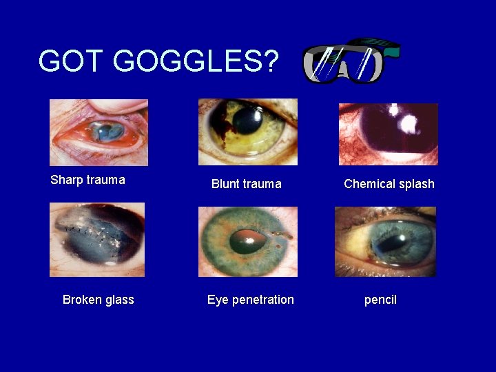 GOT GOGGLES? Sharp trauma Broken glass Blunt trauma Eye penetration Chemical splash pencil 