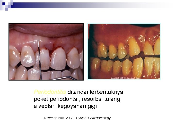 Periodontitis ditandai terbentuknya poket periodontal, resorbsi tulang alveolar, kegoyahan gigi Newman dkk, 2000. Clinical