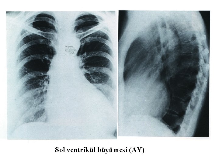 Sol ventrikül büyümesi (AY) 