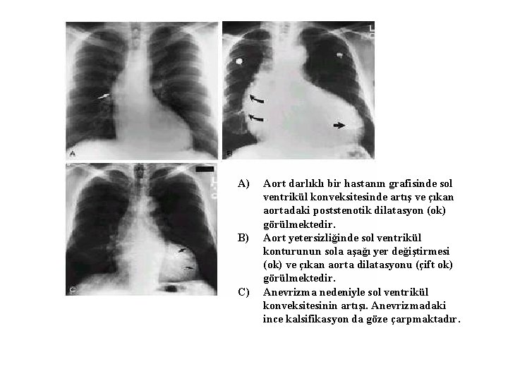 A) B) C) Aort darlıklı bir hastanın grafisinde sol ventrikül konveksitesinde artış ve çıkan