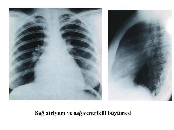 Sağ atriyum ve sağ ventrikül büyümesi 