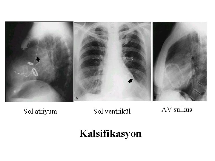 Sol atriyum Sol ventrikül Kalsifikasyon AV sulkus 