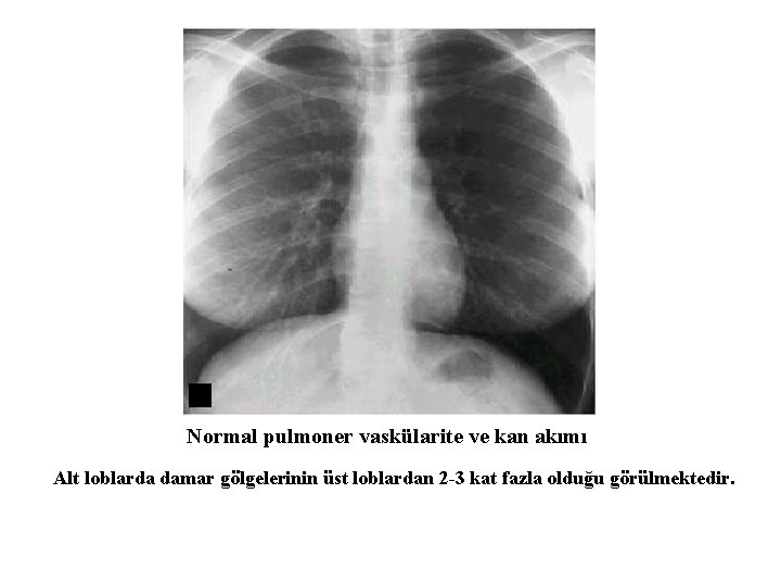 Normal pulmoner vaskülarite ve kan akımı Alt loblarda damar gölgelerinin üst loblardan 2 -3