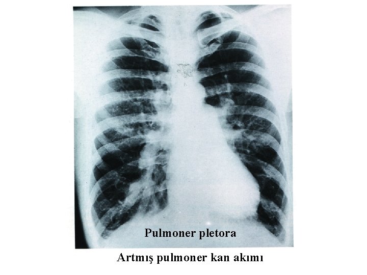 Pulmoner pletora Artmış pulmoner kan akımı 