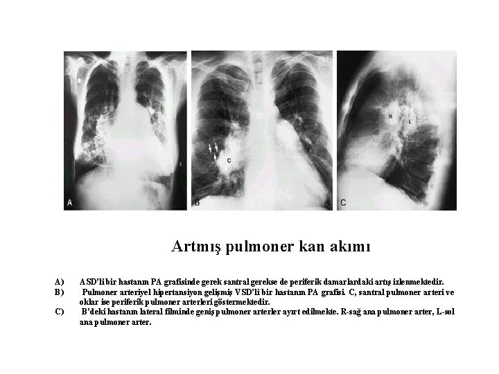 Artmış pulmoner kan akımı A) B) C) ASD’li bir hastanın PA grafisinde gerek santral