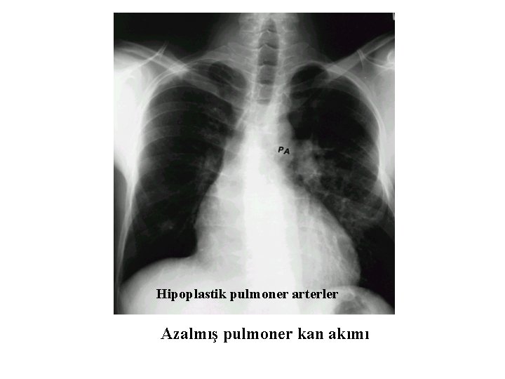 Hipoplastik pulmoner arterler Azalmış pulmoner kan akımı 