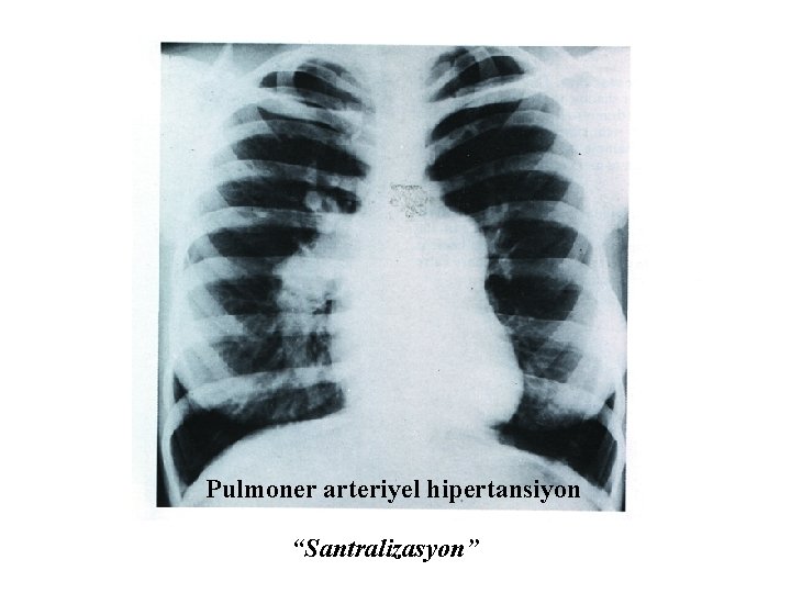 Pulmoner arteriyel hipertansiyon “Santralizasyon” 