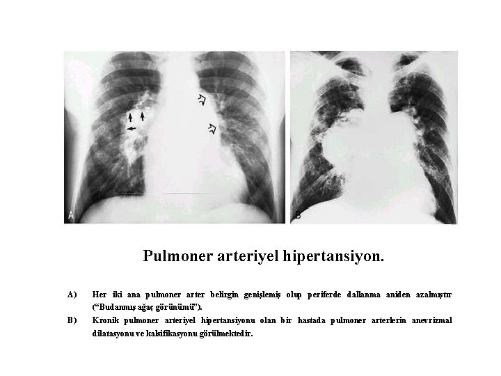 Pulmoner arteriyel hipertansiyon. A) Her iki ana pulmoner arter belirgin genişlemiş olup periferde dallanma