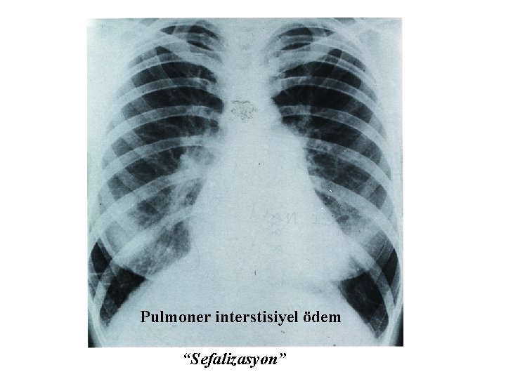 Pulmoner interstisiyel ödem “Sefalizasyon” 
