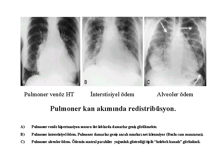 Pulmoner venöz HT İnterstisiyel ödem Alveoler ödem Pulmoner kan akımında redistribüsyon. A) Pulmoner venöz
