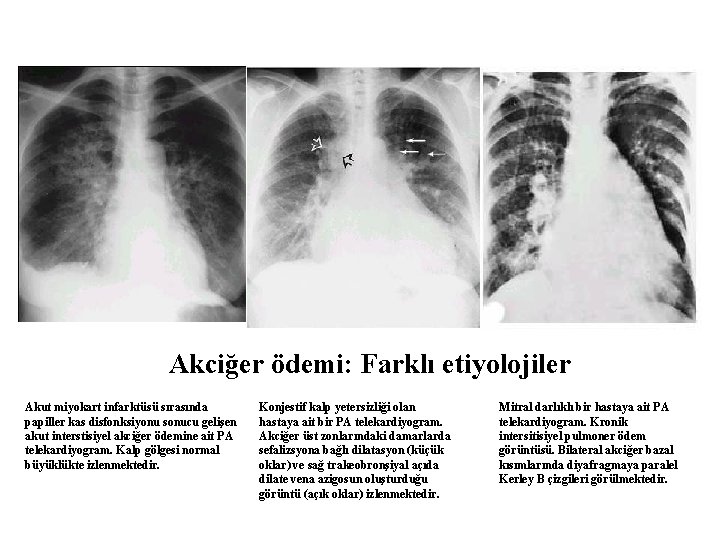 Akciğer ödemi: Farklı etiyolojiler Akut miyokart infarktüsü sırasında papiller kas disfonksiyonu sonucu gelişen akut