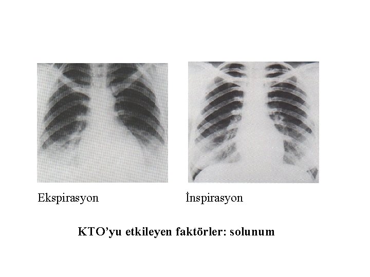 Ekspirasyon İnspirasyon KTO’yu etkileyen faktörler: solunum 