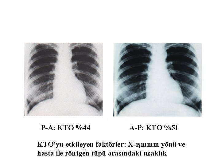 P-A: KTO %44 A-P: KTO %51 KTO’yu etkileyen faktörler: X-ışınının yönü ve hasta ile