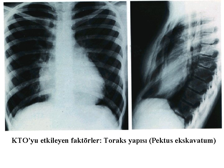 KTO’yu etkileyen faktörler: Toraks yapısı (Pektus ekskavatum) 