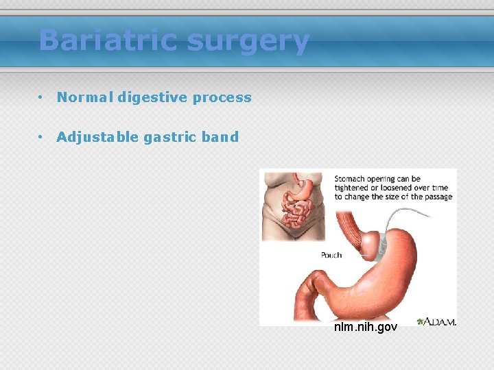 Bariatric surgery • Normal digestive process • Adjustable gastric band nlm. nih. gov 