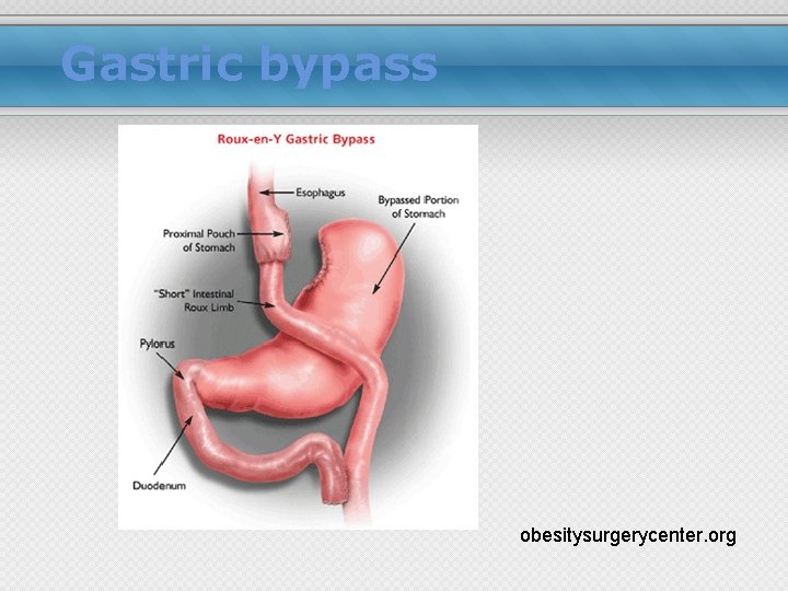 Gastric bypass obesitysurgerycenter. org 