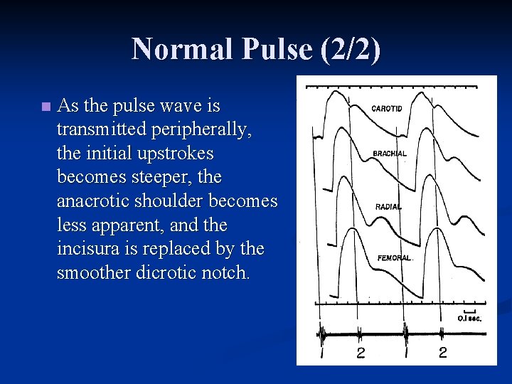 Normal Pulse (2/2) n As the pulse wave is transmitted peripherally, the initial upstrokes Normal Pulse (2/2) n As the pulse wave is transmitted peripherally, the initial upstrokes