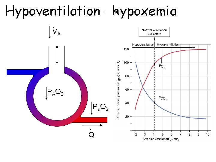 Hypoventilation →hypoxemia • VA P AO 2 P a. O 2 • Q 