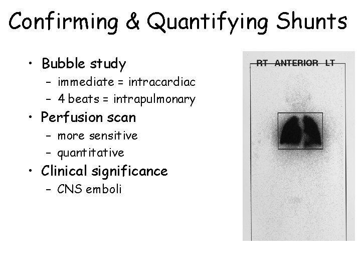 Confirming & Quantifying Shunts • Bubble study – immediate = intracardiac – 4 beats