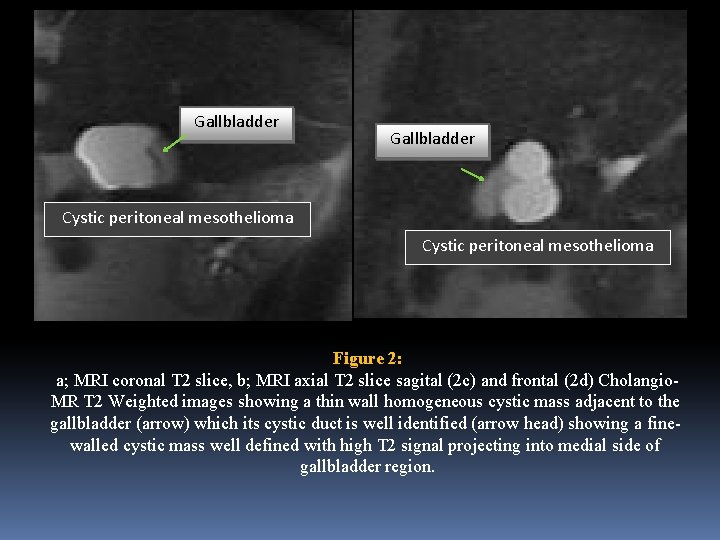 Gallbladder Cystic peritoneal mesothelioma Figure 2: a; MRI coronal T 2 slice, b; MRI