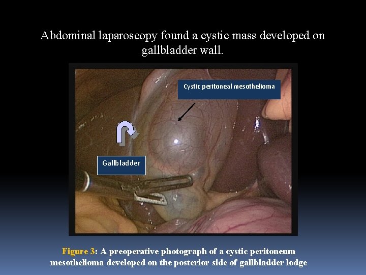 Abdominal laparoscopy found a cystic mass developed on gallbladder wall. Cystic peritoneal mesothelioma Gallbladder