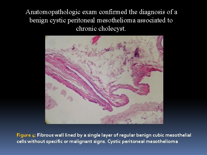 Anatomopathologic exam confirmed the diagnosis of a benign cystic peritoneal mesothelioma associated to chronic