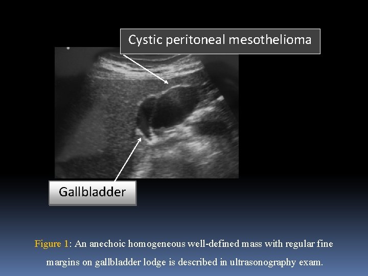 Cystic peritoneal mesothelioma Gallbladder Figure 1: An anechoic homogeneous well-defined mass with regular fine